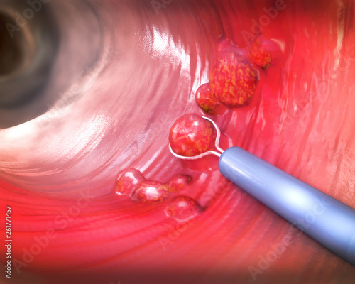 Removal of a colonic polyp with a electrical wire loop during a colonoscopy - 3d illustration