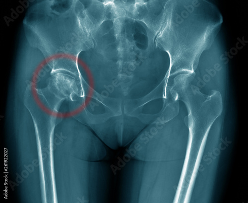 x-ray image of old woman show degenerative change of hip joint, hip avascular necrosis right side of alderly