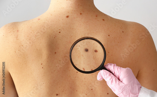 Dermatologist examining moles of patient in clinic