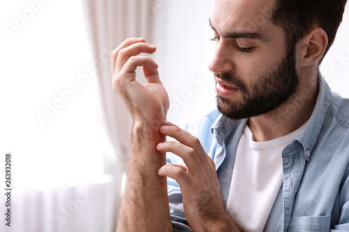 Young man scratching hand indoors, space for text. Allergies symptoms