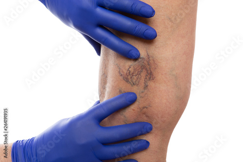 Doctor checking varices on leg of patient