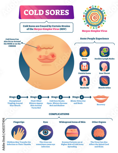 Cold sores vector illustration. Medical labeled herpes simplex virus scheme