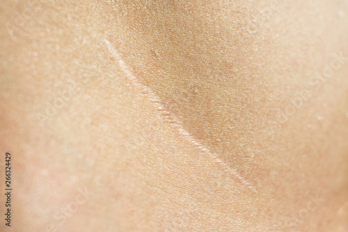 Close-up, beautiful surgical scar on the skin after appendectomy 