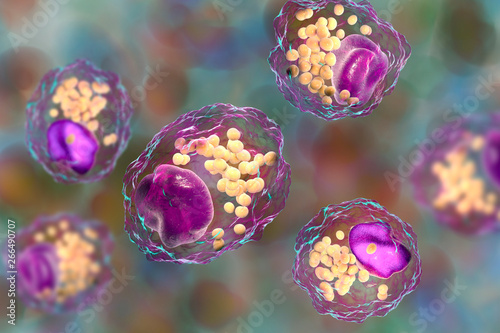 Foam cell, a macrophage cell with lipid droplets