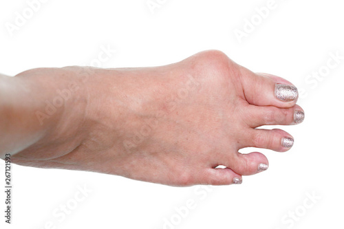 isolated background of foot deformity called bunion deformity or hallux valgus