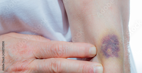 A strong hematoma due to a wrong injection. Concept medical mistakes.