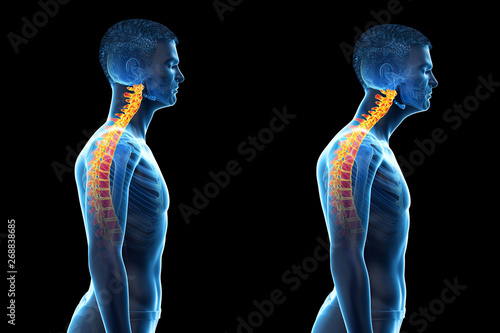 3d rendered medically accurate illustration of a man with a forward head posture