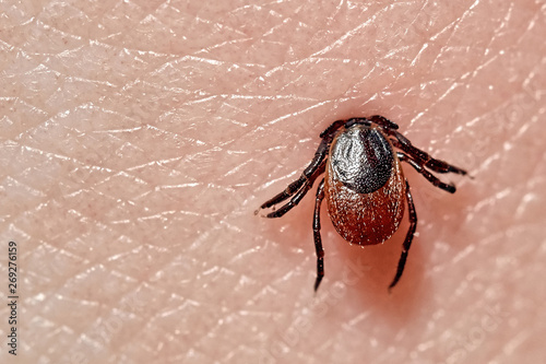 Sucking tick Macro photo on human skin. Ixodes ricinus. Bloated parasite bitten into pink irritated epidermis. Small red drops. Dangerous insect mite. Encephalitis, Lyme disease infection.