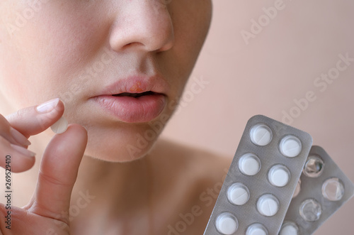 Part of a young woman's face with a virus herpes simplex on lips, treatment with pills