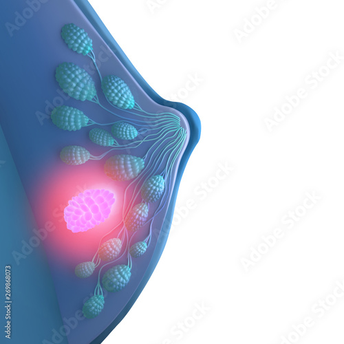 Breast cancer With Side post 3D Render