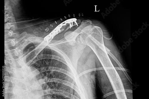 A shouder film xray of a patient with fractured clavicle