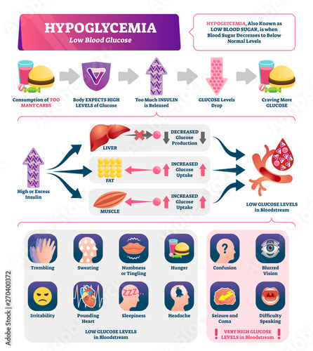 Hypoglycemia vector illustration. Labeled low sugar level medical scheme.