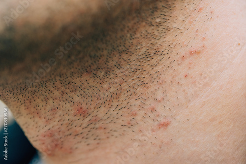 Bristles on the guy's face and neck. Red pimples on the skin. Irritation on the skin from shaving.