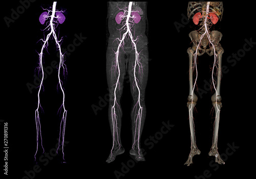 Comparison of CTA femoral artery run off 3D rendering image of femoral artery with kidney for Patients Presenting with Acute or Chronic Peripheral Arterial Disease.