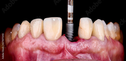 inserting the dental implant