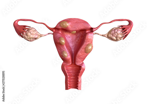 uterine fibroid are benign solid tumors formed by muscle tissue. Its size can vary greatly and some cause large abdomen increase