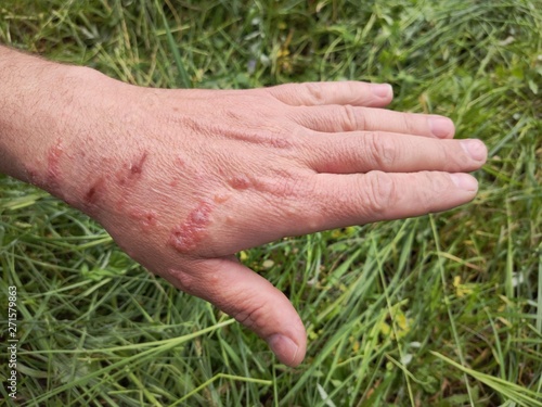 First degree burn of skin, closeup. Burns of hand, wounds. Influence poison of Heracleum (Giant Hogweed, Cow parsnip) on skin. One week after defeat poison