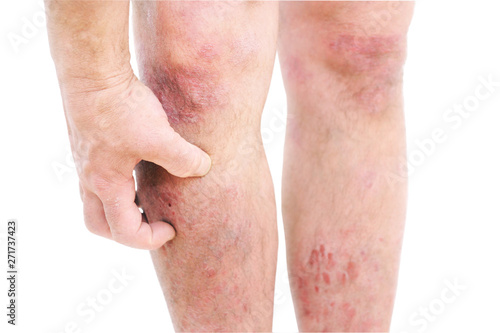 Atopic dermatitis (AD), also known as atopic eczema, is a type of skin inflammation (dermatitis) .