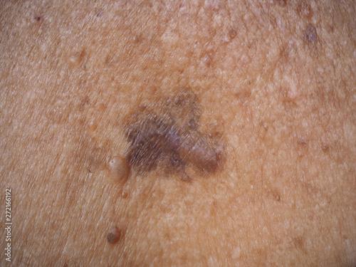 skin cancer or melanoma on collarbone type of superficial spreading be an existing spot, freckle or mole change color, size or shape caused by ultraviolet (UV) light damaging the DNA in skin cells.