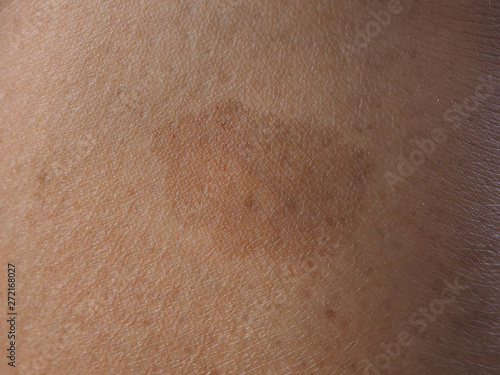 dark brow birthmark or cafe au lait ma or CLAMs on the skin leg woman using for health care and treatment pulsed dye laser concept.