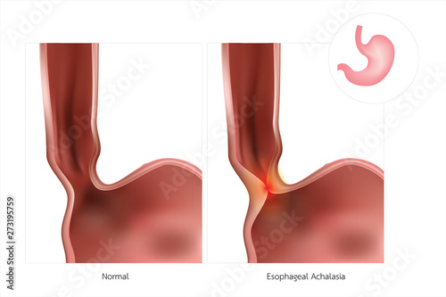 The stomach or esophagus is often referred to as simple Achalasia. The lower esophageal sphincter does not relax, causing inflammation.