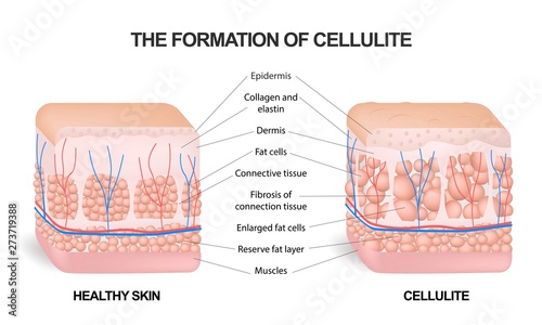 The formation of cellulite. Cellulite occurs in most females and rarely in males. Vector diagram. Comparative illustration of normal skin and cellulite s skin.