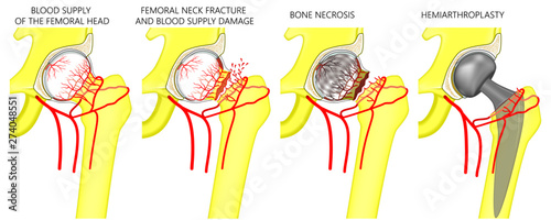 Vector illustration of femoral head blood supply, femoral neck fracture and blood vessels problem, femoral head necrosis and hemiarthroplasty of the hip. For advertising and medical publications.