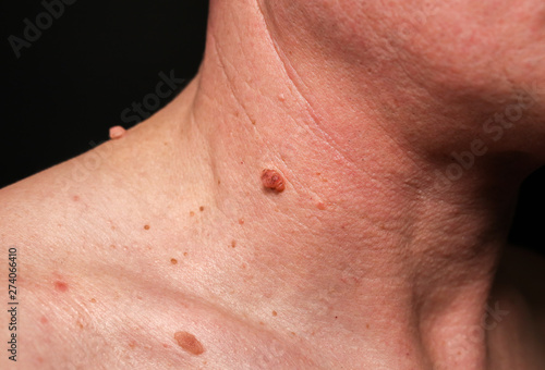 Big birthmark on the man's skin. Medical health photo. Papillomas on the neck.