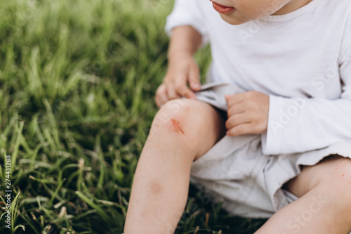 photo of a little girl who fell and scratched his knee in the blood, it hurts the wound and it keeps a handle on the leg, but not crying
