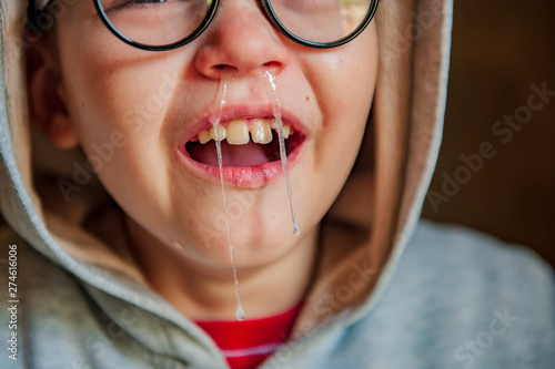 Cute little boy from school for children with poor eyesight holds inhaler in his hands to spray medication. Unhappy chilld cries intensely with tears and snot. Shallow focus