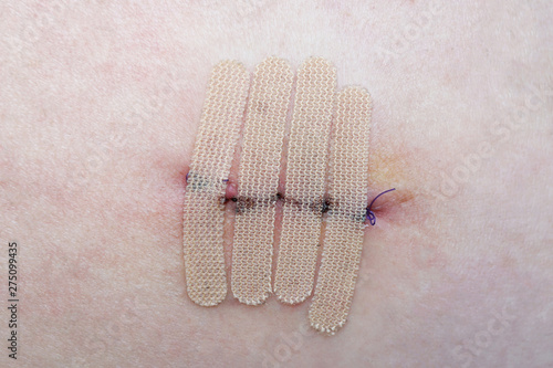 close-up of human skin with suture and wound closure strips or surgical tape after mole or melanoma biopsy