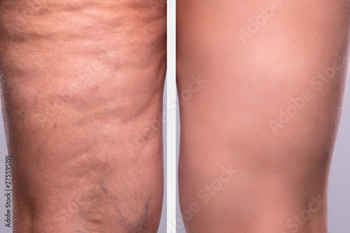 Person's Leg Before And After Cellulite Treatment