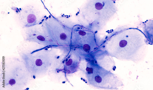 Endoscopic esophageal brushing cytology showing squamous cells with yeast and pseudohyphae of Candida albicans, a type of fungal infection, from a cancer patient with candidiasis (thrush)