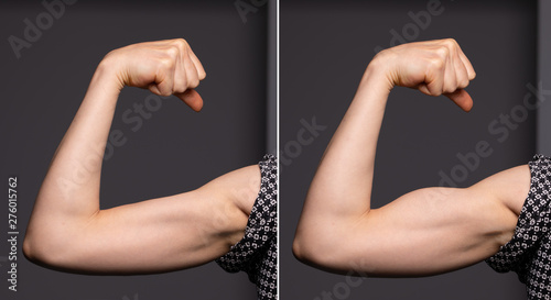 A before and after view on the arm of a young Caucasian woman. Showing toned biceps after spending time at the gym and working out.