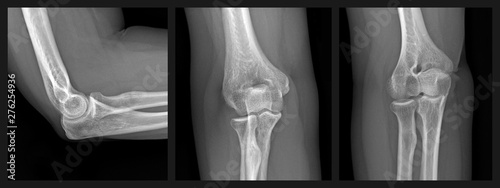 X-ray series of a human elbow joint showing the humerus bone of the upper arm and the radius and ulna bones of the forearm.