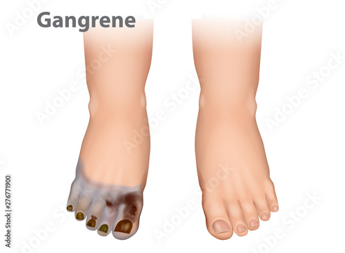 Gangrene is a type of tissue death caused. Diabetic Arterial Disease showing gangrene and ulcerations of the toes.