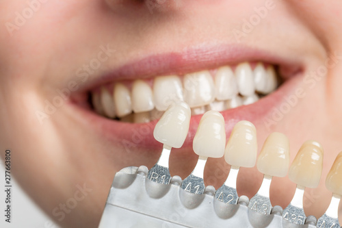 using shade guide at woman's mouth to check veneer of teeth for bleaching