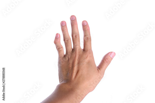 The left hand little finger or pinky finger is deformity isolated on white background.