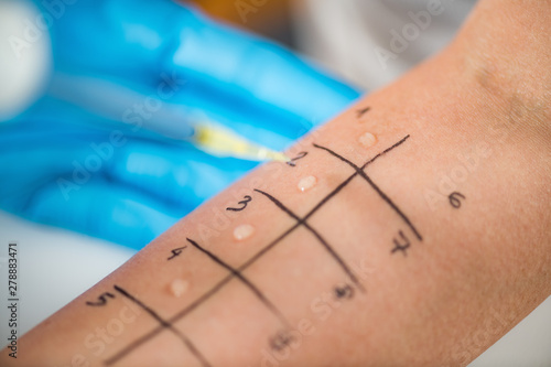 Allergy - Skin Prick Testing