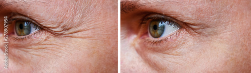 Procedure for the rejuvenation of wrinkles around the eyes, crow's feet, before and after effect