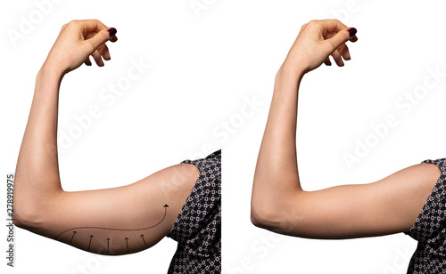 Arrows show the before and after results of a successful brachioplasty, a surgical procedure to remove excess fat in the upper arms. Isolated on white backdrop.