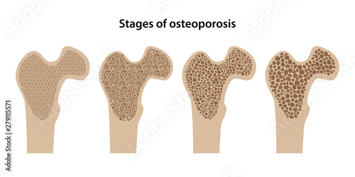 Stages of osteoporosis are isolated on white background. Vector illustration in flat style