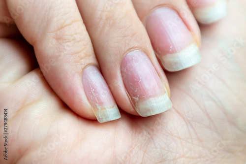 Damaged nails that have problem after doing manicure. Health and beauty problem.
