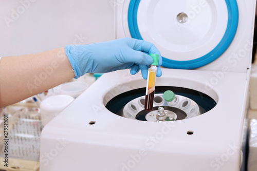 Medical tube with blood plasma in hand for PRP, extracted from centrifuge for plasma lifting