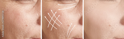 woman wrinkles face before and after treatment, arrow,