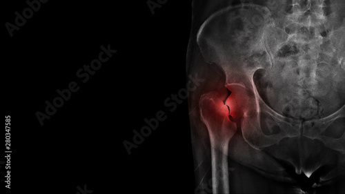 Film X ray hip radiograph show broken hip bone ( neck of femur fracture ). The elderly patient has osteoporosis disease and accidental fall at home. Home health care and Fall prevention concept. 