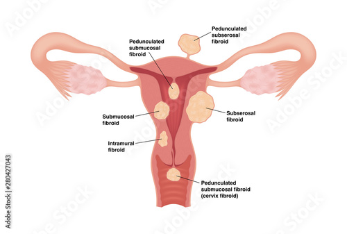 Types of uterine fibroids. Vector medical illustration with inscroptions isolated on white background.