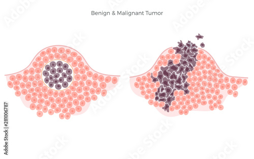 Vector illustration of malignant and benign tumor