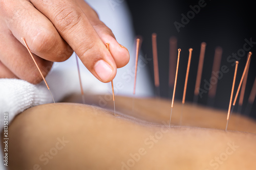 Close-up of senior female back with steel needles during procedure of acupuncture therapy