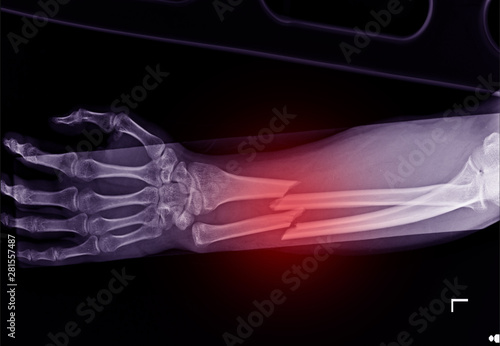 X-ray forearm fracture shaft of radius and ulnar bone